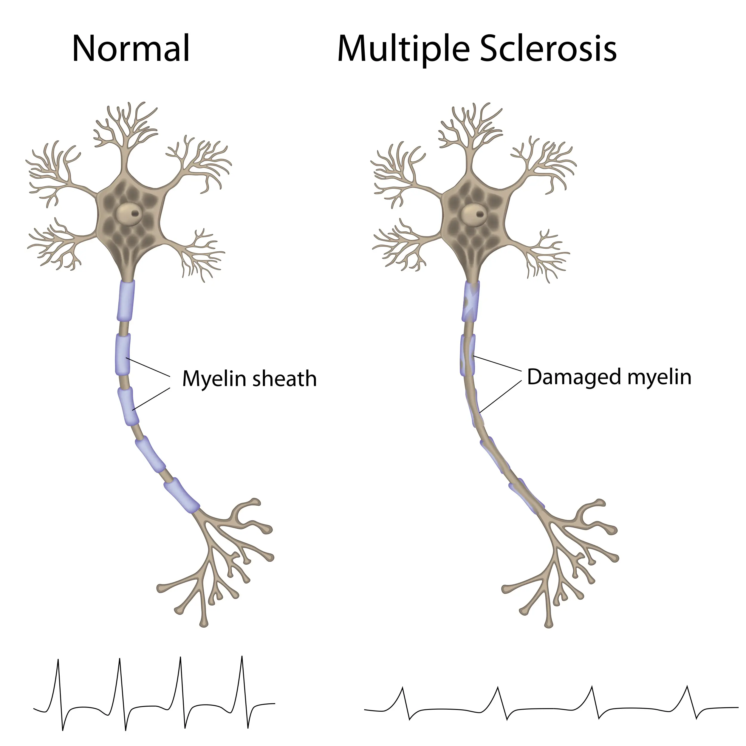 What Is Multiple Sclerosis MS Critical Care Training Center What Is Multiple Sclerosis MS Critical Care Training Center